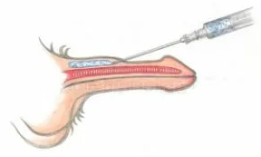 Hyaluronsäure-Injektionen