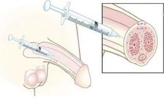 Penisvergrößerung mit Hyaluronsäure-Injektionen